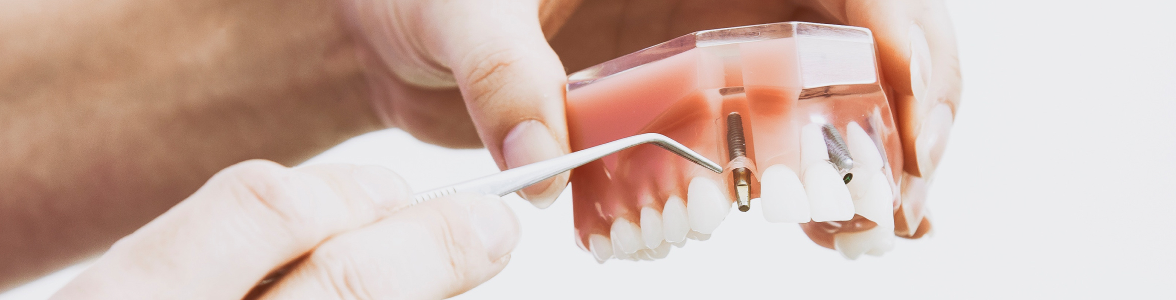 Imagen de cabecera sobre implantología en la clínica dental Andoni Guisasola